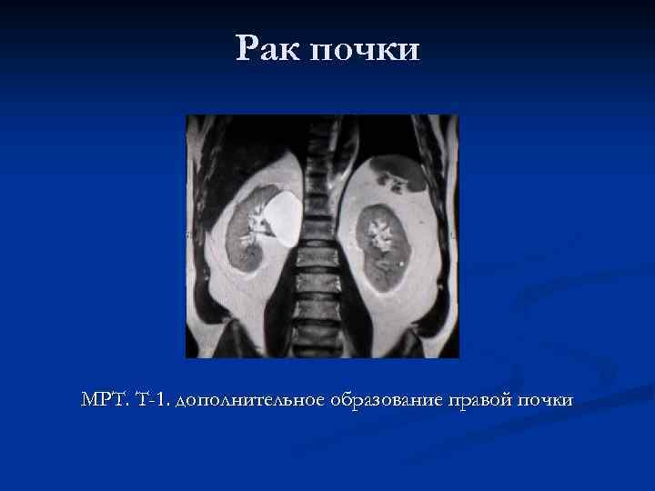 Рак почки МРТ. Т-1. дополнительное образование правой почки 