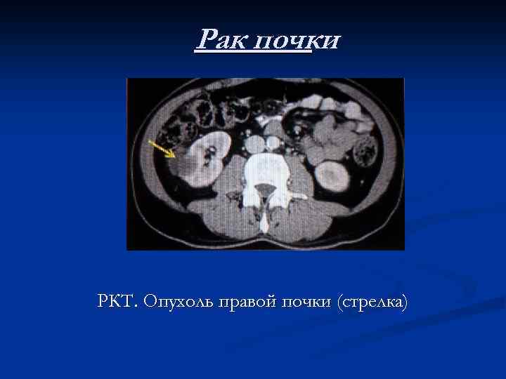 Рак почки РКТ. Опухоль правой почки (стрелка) 