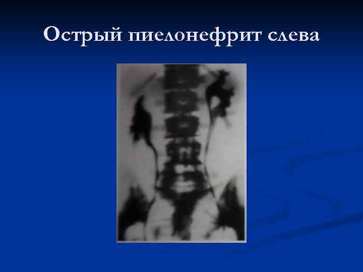 Острый пиелонефрит слева 