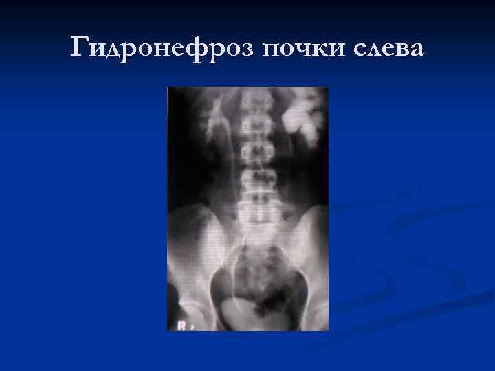 Гидронефроз почки слева 