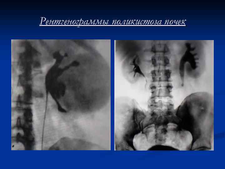 Рентгенограммы поликистоза почек 