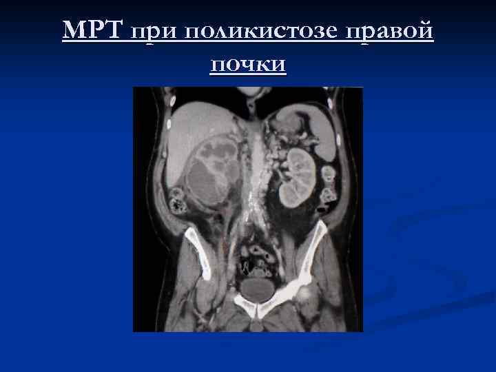 МРТ при поликистозе правой почки 
