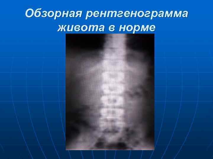 Обзорная рентгенограмма живота в норме 