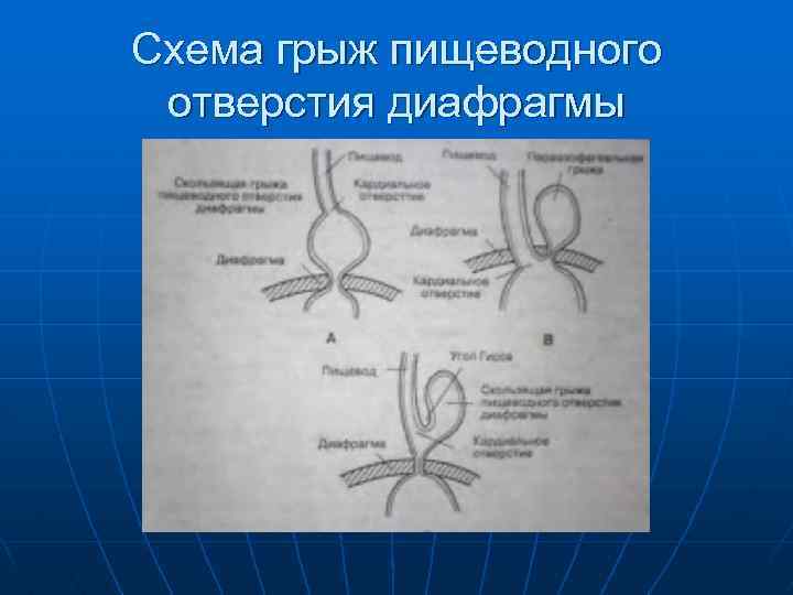 Схема грыж пищеводного отверстия диафрагмы 