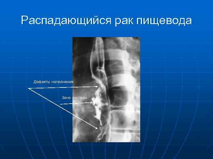 Распадающийся рак пищевода Дефекты наполнения Зона распада 