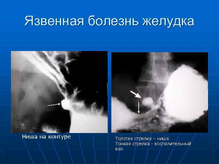 Язвенная болезнь желудка Ниша на контуре Толстая стрелка – ниша Тонкая стрелка - воспалительный