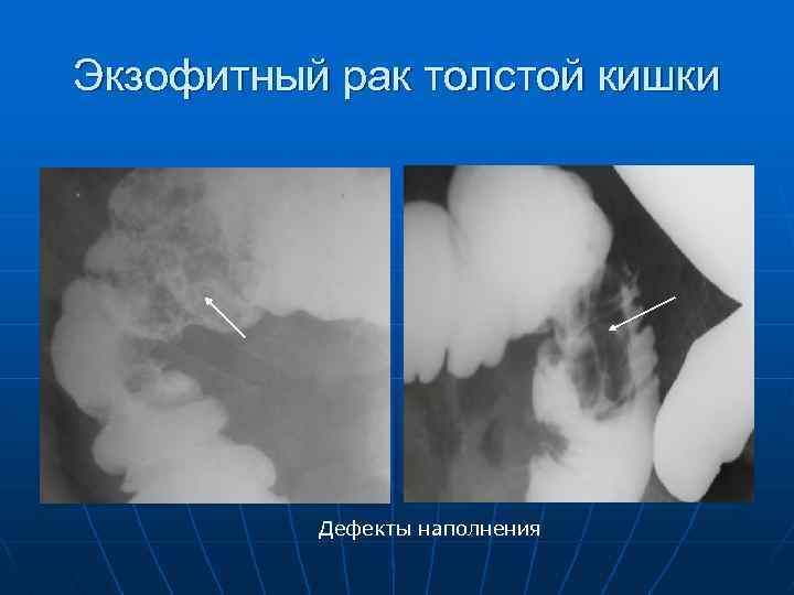 Экзофитный рак толстой кишки Дефекты наполнения 