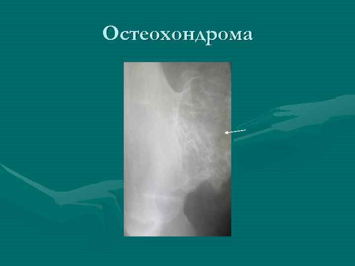 Остеохондрома 