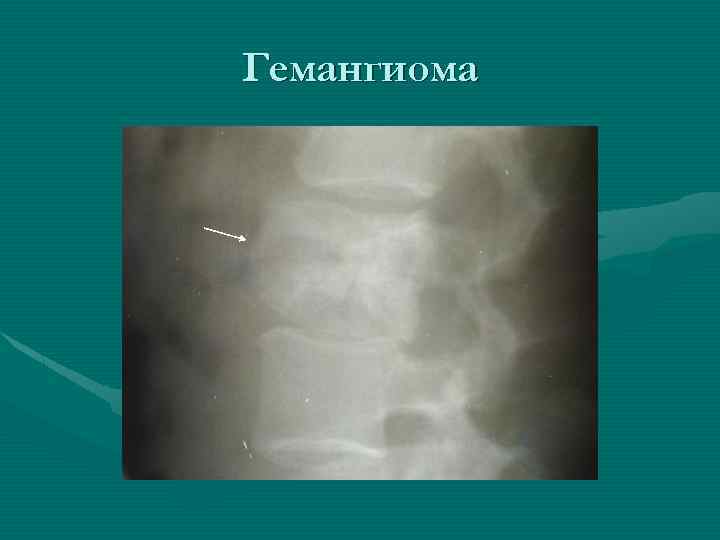 Гемангиома 