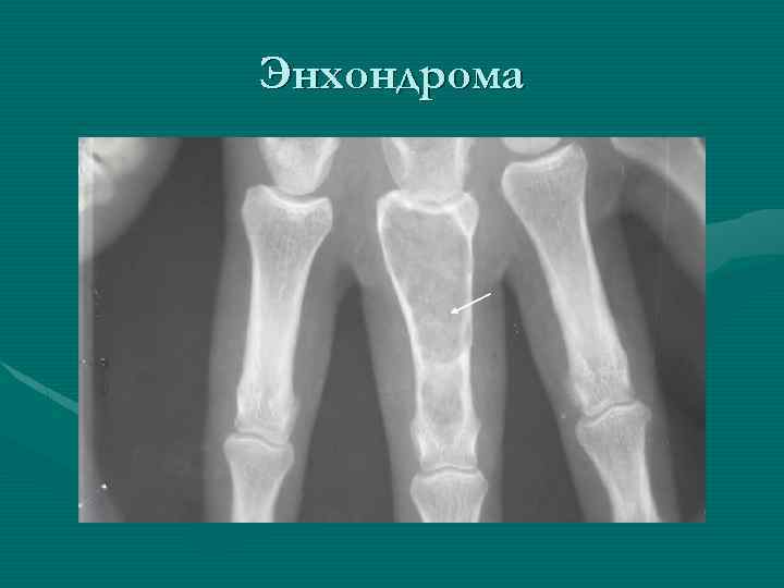 Энхондрома 