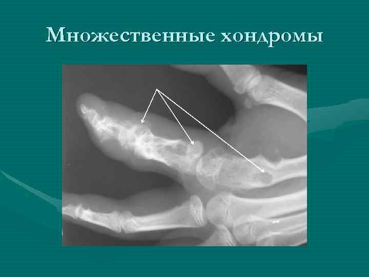 Множественные хондромы 