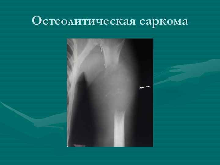 Остеолитическая саркома 