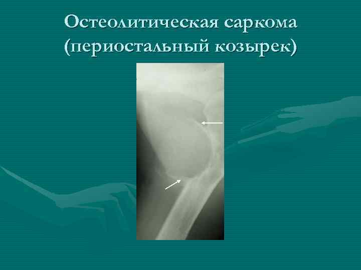 Остеолитическая саркома (периостальный козырек) 