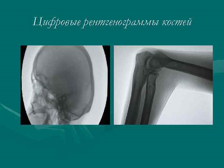 Цифровые рентгенограммы костей 