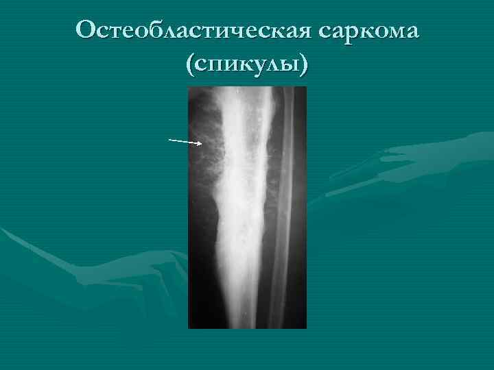 Остеобластическая саркома (спикулы) 