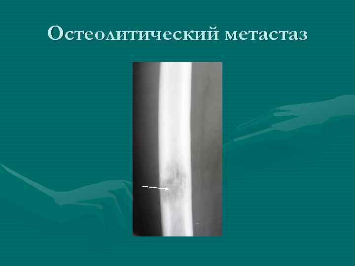 Остеолитический метастаз 