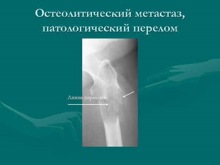 Остеолитический метастаз, патологический перелом Линия перелома 