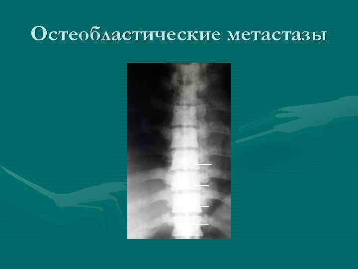 Остеобластические метастазы 