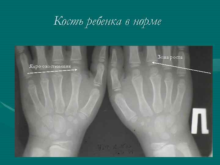 Кость ребенка в норме Зона роста Ядро окостенения 