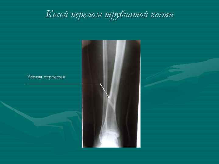 Косой перелом трубчатой кости Линия перелома 