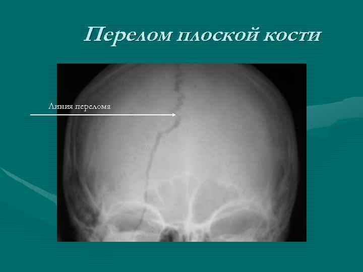 Перелом плоской кости Линия перелома 