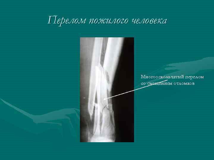 Перелом пожилого человека Многооскольчатый перелом со смещением отломков 