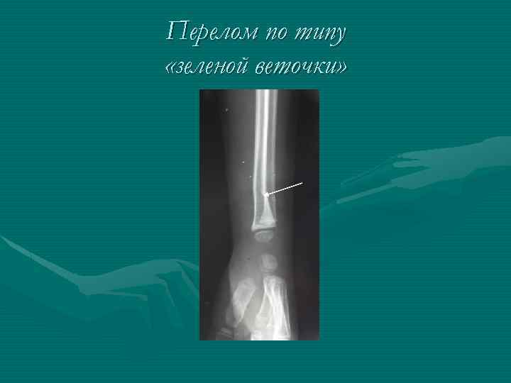 Перелом по типу «зеленой веточки» 