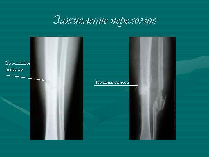 Заживление переломов Сросшийся перелом Костная мозоль 
