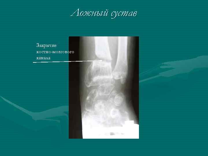 Ложный сустав Закрытие костно-мозгового канала 