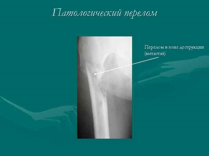 Патологический перелом Перелом в зоне деструкции (метастаз) 