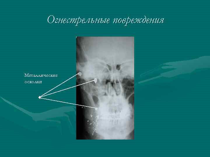 Огнестрельные повреждения Металлические осколки 