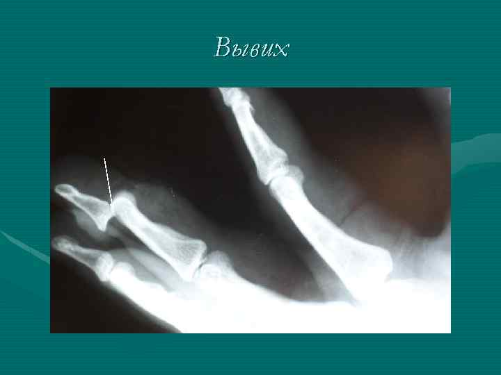 Вывих 
