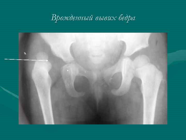 Врожденный вывих бедра 