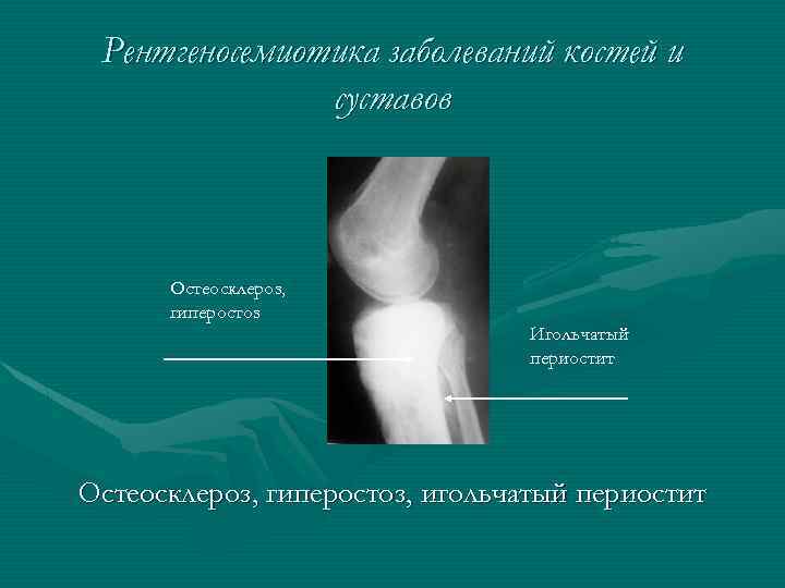 Рентгеносемиотика заболеваний костей и суставов Остеосклероз, гиперостоз Игольчатый периостит Остеосклероз, гиперостоз, игольчатый периостит 