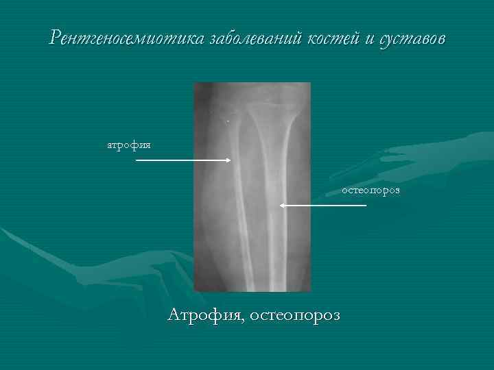Рентгеносемиотика заболеваний костей и суставов атрофия остеопороз Атрофия, остеопороз 