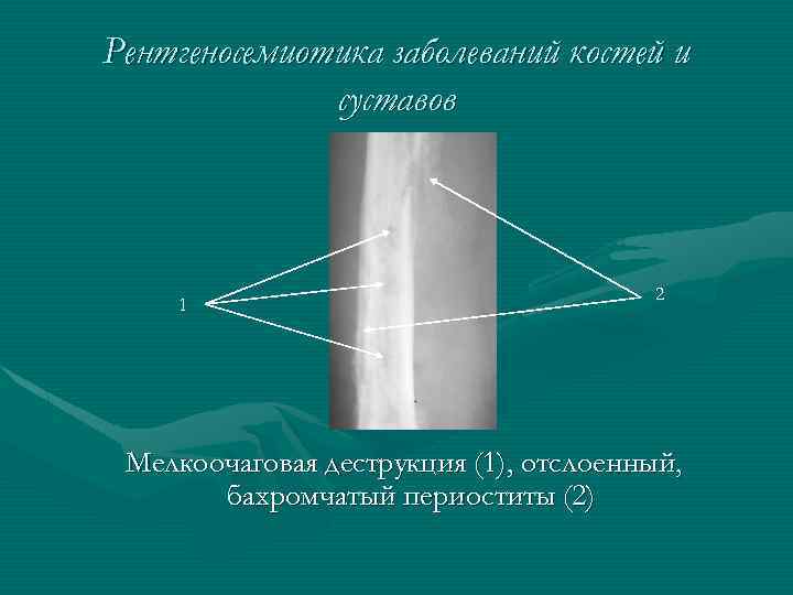 Рентгеносемиотика заболеваний костей и суставов 1 2 Мелкоочаговая деструкция (1), отслоенный, бахромчатый периоститы (2)
