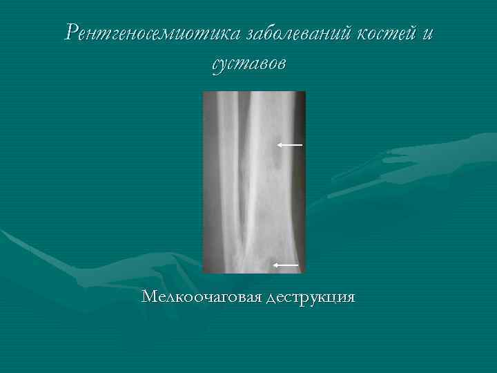 Рентгеносемиотика заболеваний костей и суставов Мелкоочаговая деструкция 