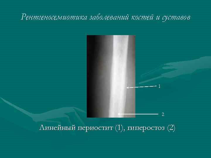 Рентгеносемиотика заболеваний костей и суставов 1 2 Линейный периостит (1), гиперостоз (2) 
