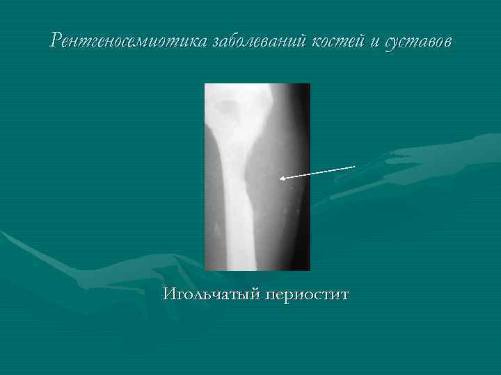 Рентгеносемиотика заболеваний костей и суставов Игольчатый периостит 