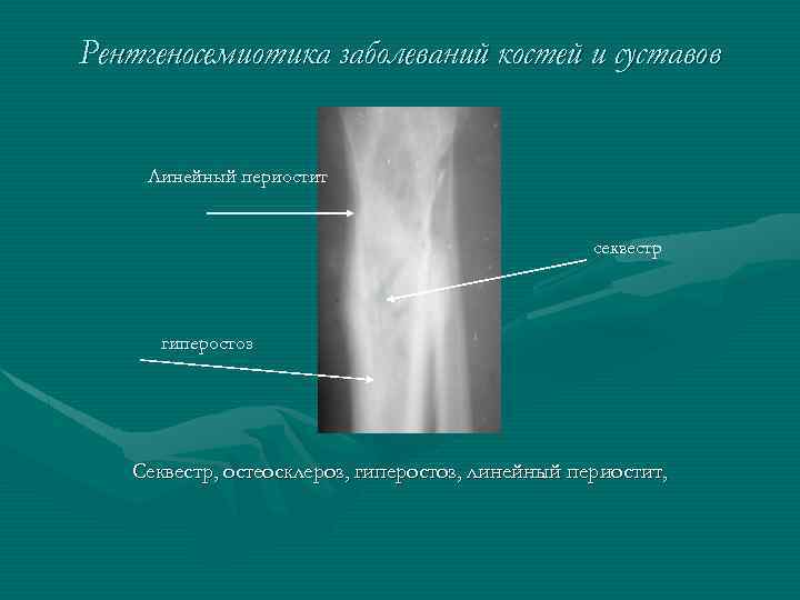 Рентгеносемиотика заболеваний костей и суставов Линейный периостит секвестр гиперостоз Секвестр, остеосклероз, гиперостоз, линейный периостит,