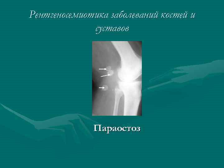 Рентгеносемиотика заболеваний костей и суставов Параостоз 