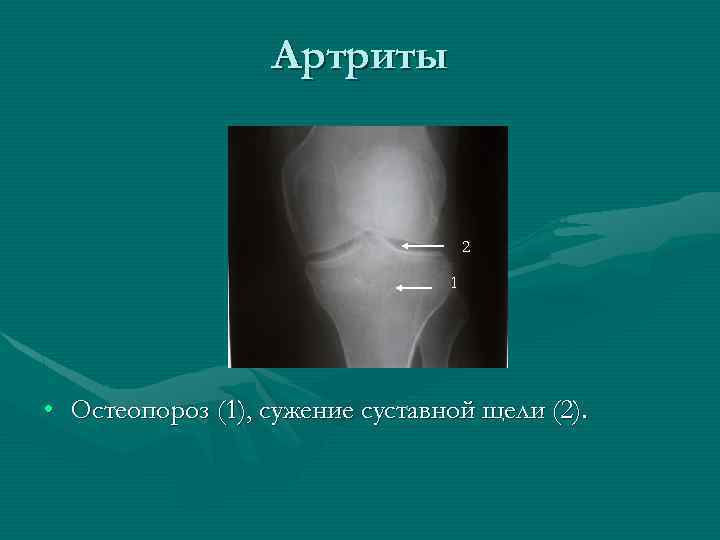 Артриты 2 1 • Остеопороз (1), сужение суставной щели (2). 