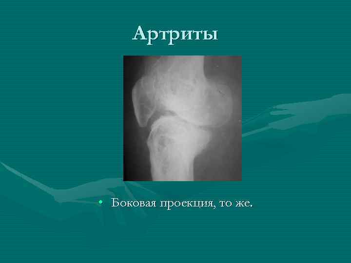 Артриты • Боковая проекция, то же. 