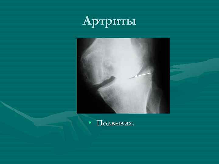Артриты • Подвывих. 