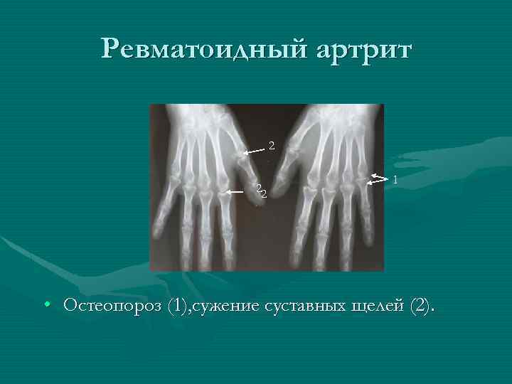 Ревматоидный артрит 2 22 1 • Остеопороз (1), сужение суставных щелей (2). 
