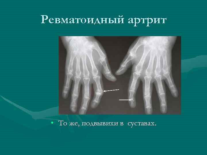 Ревматоидный артрит • То же, подвывихи в суставах. 