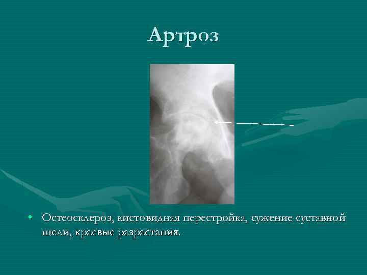 Артроз • Остеосклероз, кистовидная перестройка, сужение суставной щели, краевые разрастания. 