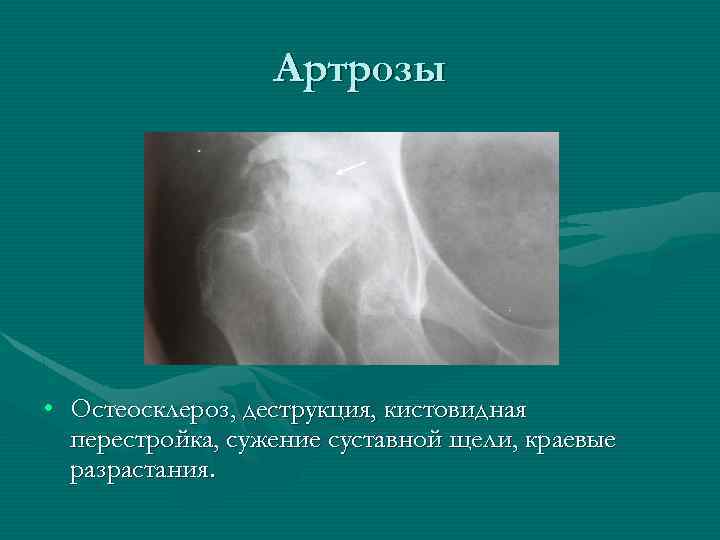 Артрозы • Остеосклероз, деструкция, кистовидная перестройка, сужение суставной щели, краевые разрастания. 