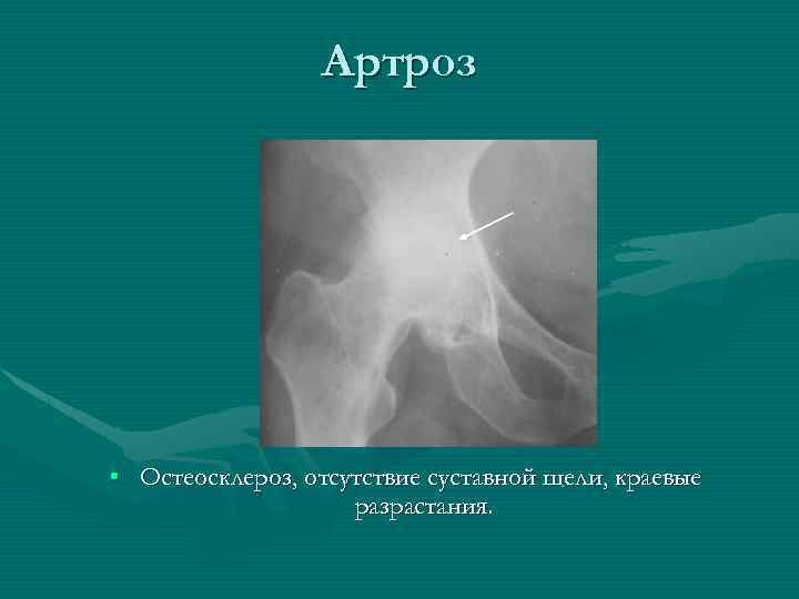 Артроз • Остеосклероз, отсутствие суставной щели, краевые разрастания. 