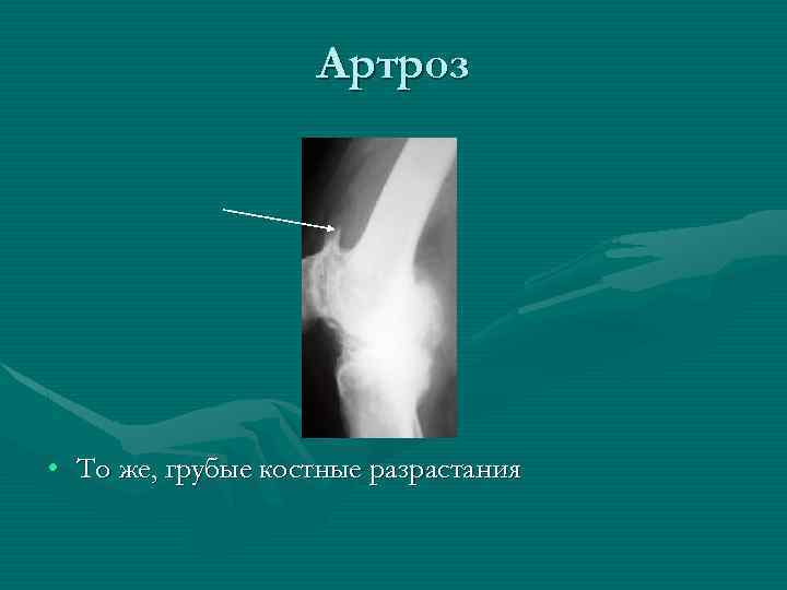 Артроз • То же, грубые костные разрастания 
